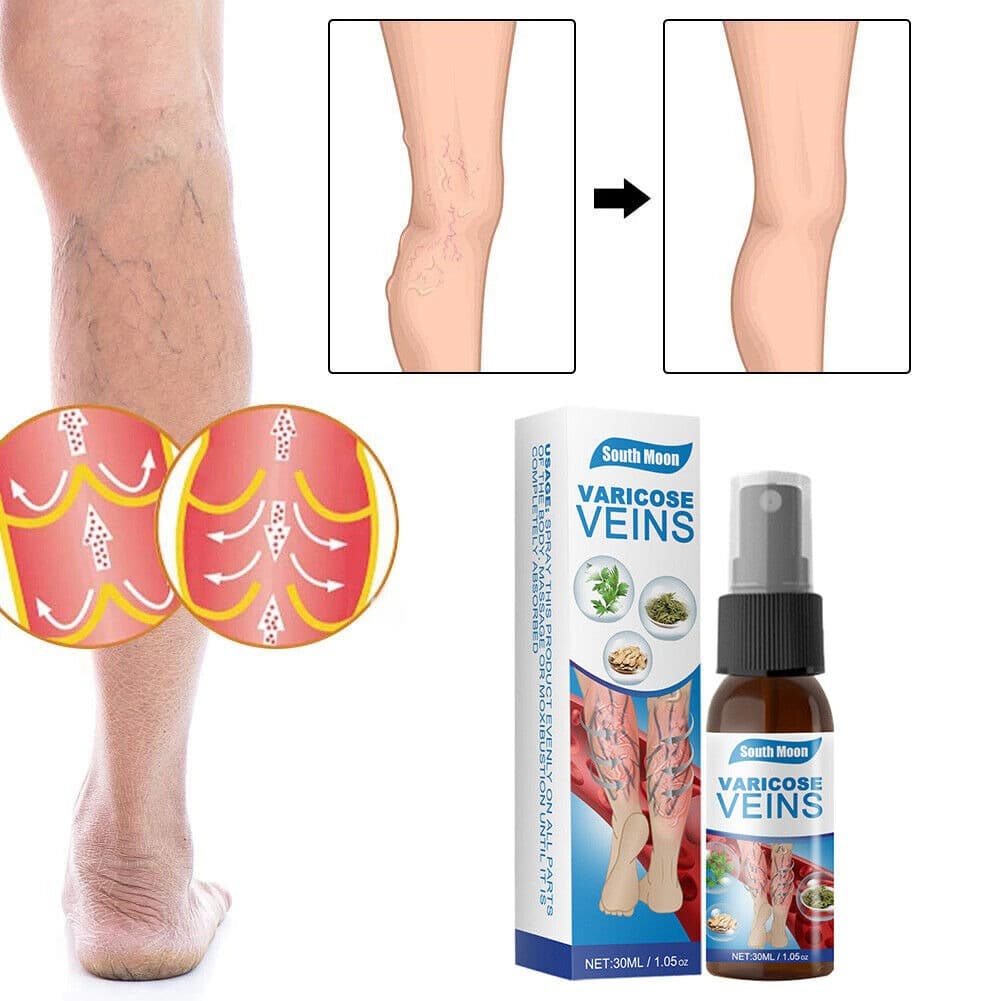 South Moon Varicose Veins Relief Spray | Herbal Varicose Vein Treatment | 30ml